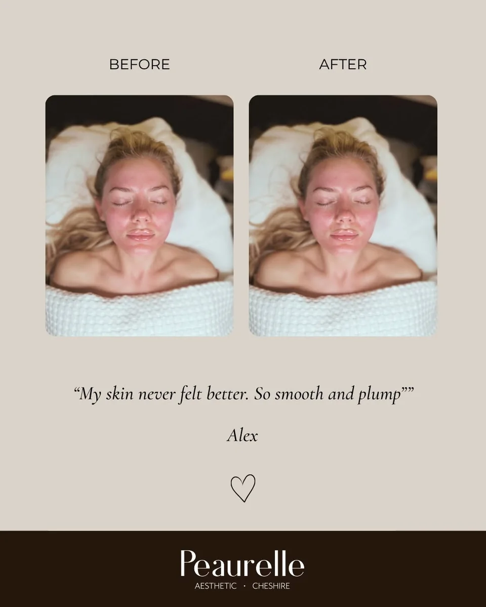 Before and after skin feedback from a Peaurelle client